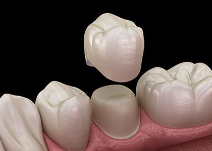 銀歯ではなく自由診療が 選ばれるのは何故？？