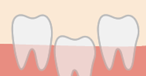 歯の嵌入